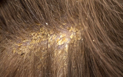 Dry or Flaky Scalp? | ICONIC Hairdressing Evesham & Pershore